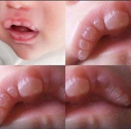 If your baby has these marks here is what it means