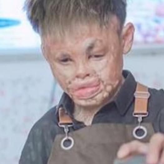 Burn survivor who didn’t leave home for 2 years now owns his own bakery – “I am more than how I look”