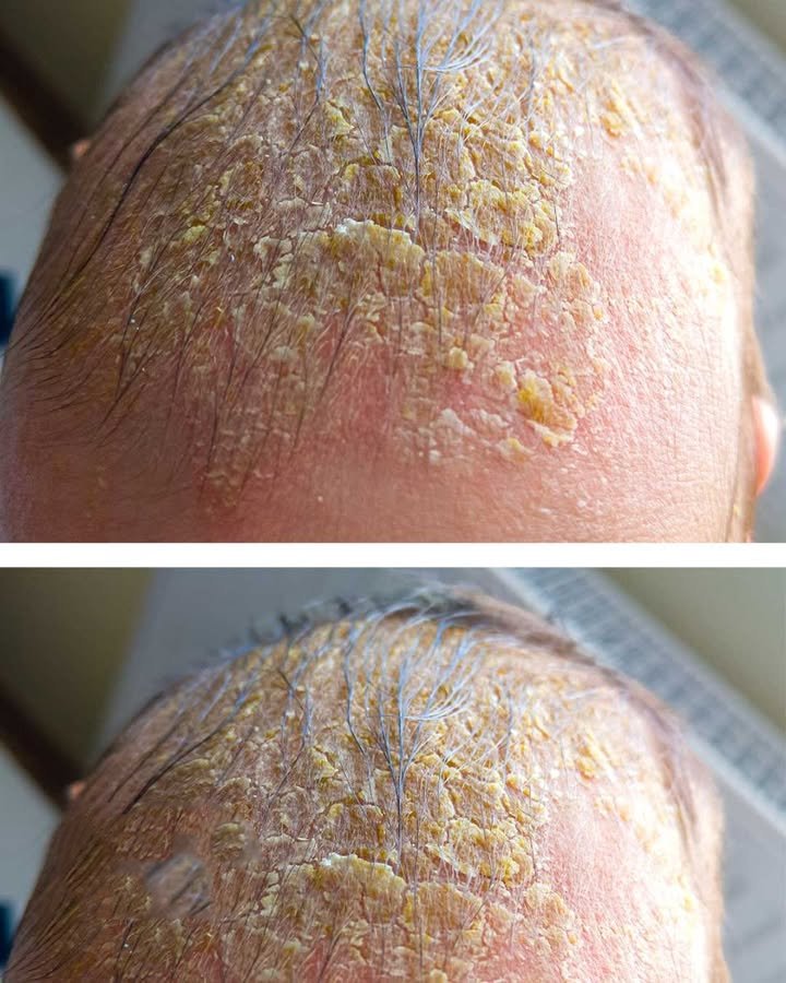 Oozing yellow crust on my scalp won’t heal. Clinic waitlist is long. What is it?