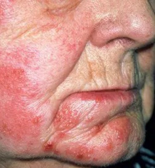 This is the silent disease that is triggered when you come into contact with …